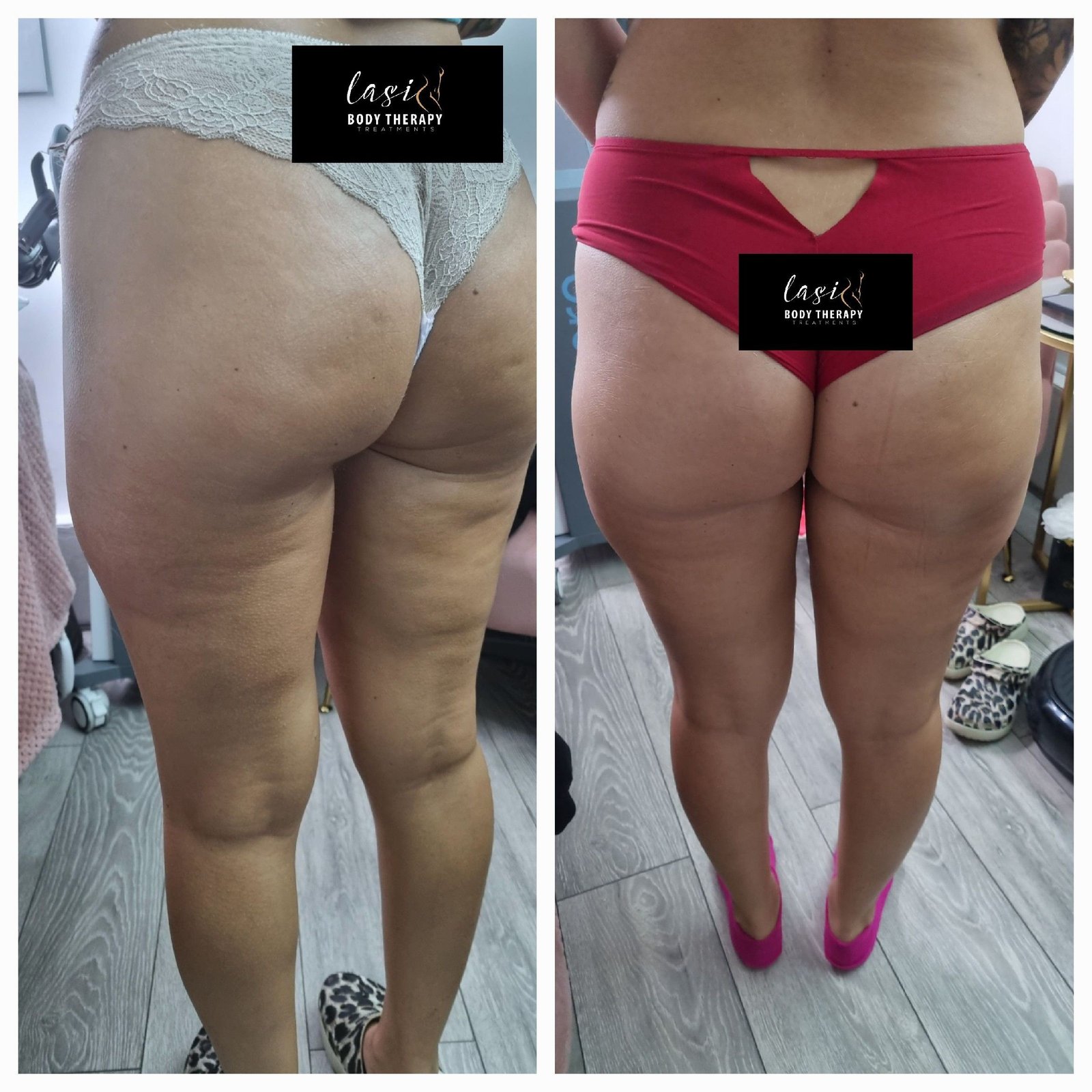 pre cellulite reduction treatment and post cellulite reduction treatment image